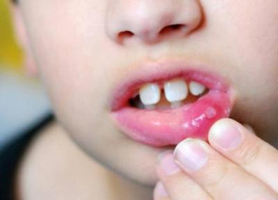 آفت دهان بچه ها چگونه درمان می شود؟